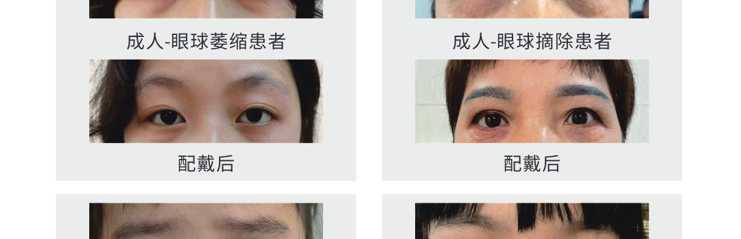 眼球萎縮定做義眼